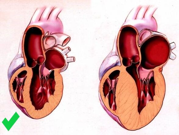 Cardione prevents ventricular hypertrophy of the heart